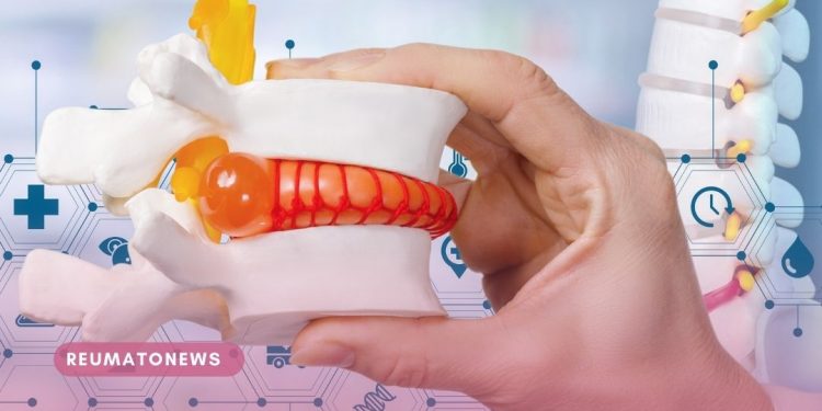 Tenho hérnia de disco, posso correr?