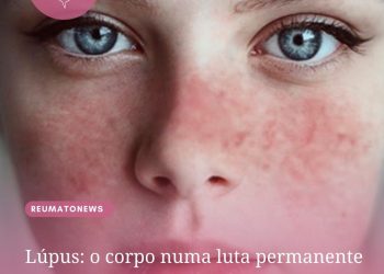 Lúpus: o corpo numa luta permanente