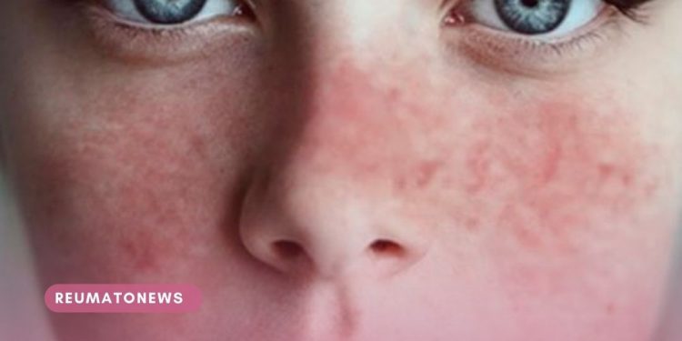 Lúpus: o corpo numa luta permanente