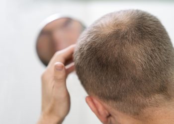 Você sofre com calvície? Veja as causas e o que pode fazer para cuidar!