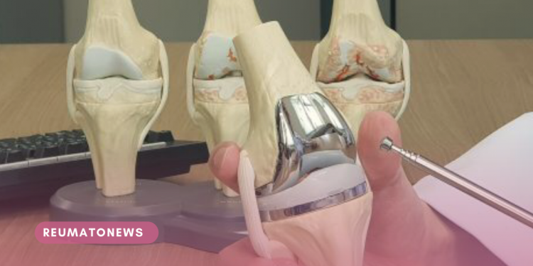 Implantes inteligentes podem ser o futuro das próteses de joelho