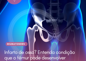 Infarto de osso? Entenda condição que o fêmur pode desenvolver
