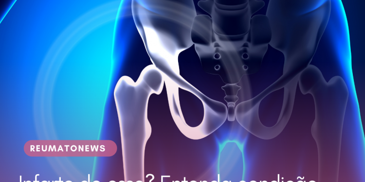 Infarto de osso? Entenda condição que o fêmur pode desenvolver