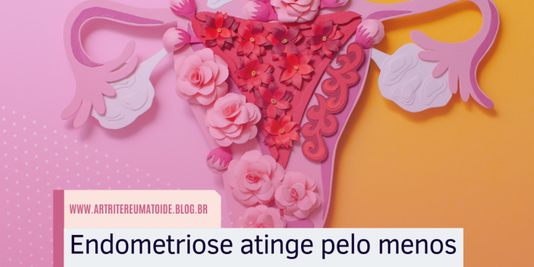 Endometriose atinge pelo menos 10% das mulheres. Conheça os sinais