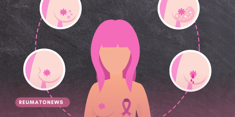 Anvisa aprova nova medicação subcutânea para mulheres com câncer de mama