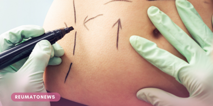 Cirurgia plástica é suficiente para modelar o corpo?