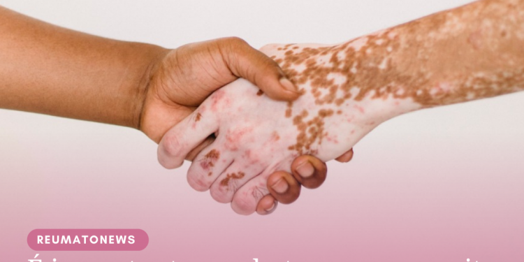 É importante combater o preconceito contra as pessoas com vitiligo, ressalta Sociedade Brasileira de Dermatologia