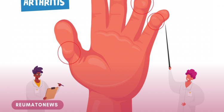 Artrite reumatoide: tudo que você precisa saber