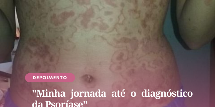 Minha jornada até o diagnóstico da Psoríase