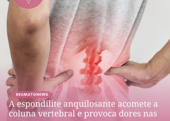 A espondilite anquilosante acomete a coluna vertebral e provoca dores nas costas