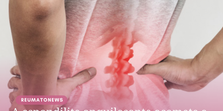 A espondilite anquilosante acomete a coluna vertebral e provoca dores nas costas