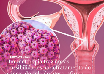 Imunoterapia traz novas possibilidades para tratamento do câncer do colo do útero, afirma oncologista