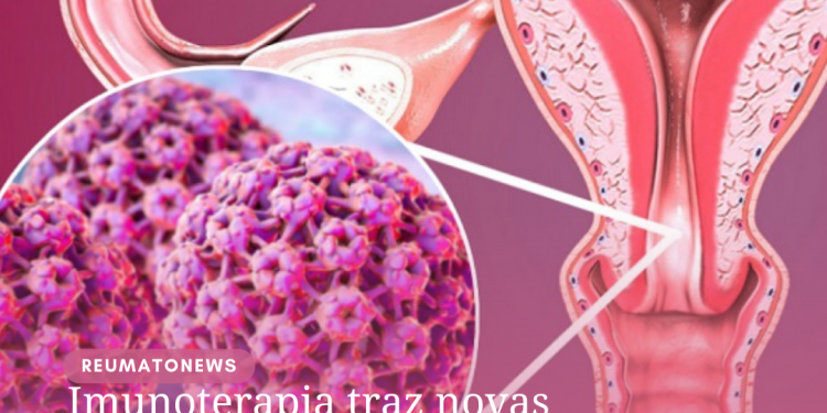 Imunoterapia traz novas possibilidades para tratamento do câncer do colo do útero, afirma oncologista