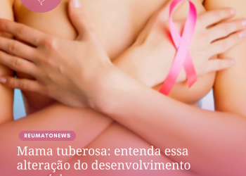 Mama tuberosa: entenda essa alteração do desenvolvimento mamário