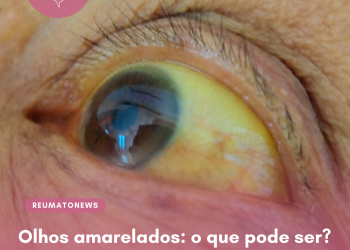 Olhos amarelados: o que pode ser?