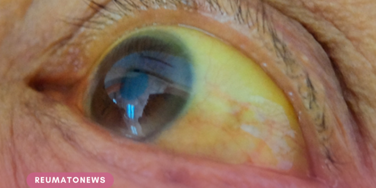 Olhos amarelados: o que pode ser?