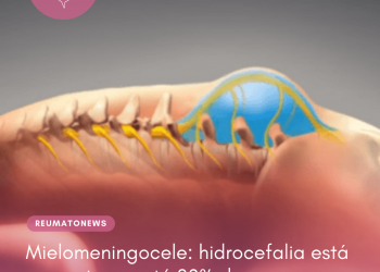 Mielomeningocele: hidrocefalia está presente em até 80% dos casos