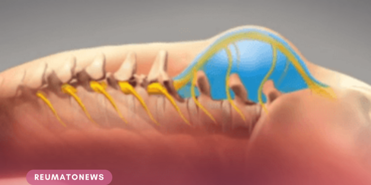 Mielomeningocele: hidrocefalia está presente em até 80% dos casos