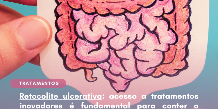 Retocolite ulcerativa: acesso a tratamentos inovadores é fundamental para conter o avanço da doença