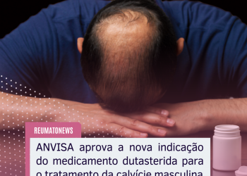 ANVISA aprova a nova indicação do medicamento dutasterida para o tratamento da calvície masculina