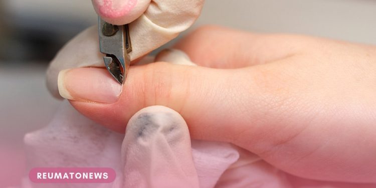 Tirar a cutícula aumenta as chances de pegar micose?