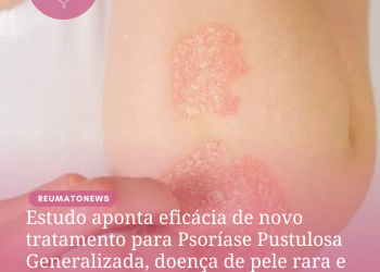 Estudo aponta eficácia de novo tratamento para Psoríase Pustulosa Generalizada, doença de pele rara e potencialmente fatal