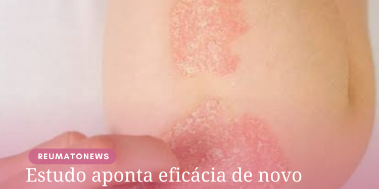 Estudo aponta eficácia de novo tratamento para Psoríase Pustulosa Generalizada, doença de pele rara e potencialmente fatal