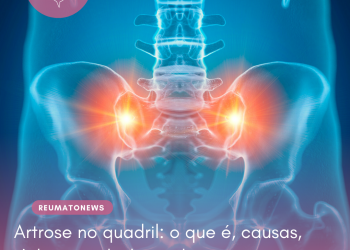 Artrose no quadril: o que é, causas, sintomas e tratamento