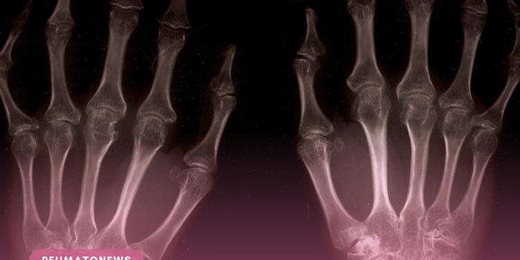 O que há de novo no tratamento da artrite reumatoide, explicado por um especialista