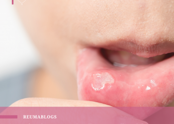 Aftas, lesões na pele, olhos vermelhos dolorosos – Já ouviu falar em Síndrome de Behçet?