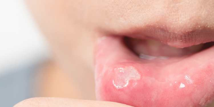 Aftas, lesões na pele, olhos vermelhos dolorosos – Já ouviu falar em Síndrome de Behçet?