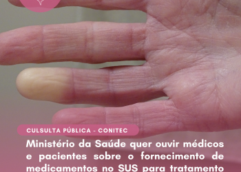 Ministério da Saúde quer ouvir médicos e pacientes sobre o fornecimento de medicamentos no SUS para tratamento da esclerose sistêmica