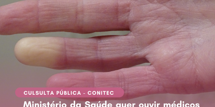 Ministério da Saúde quer ouvir médicos e pacientes sobre o fornecimento de medicamentos no SUS para tratamento da esclerose sistêmica