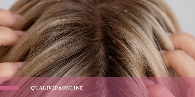 Livre-se das caspas com 4 dicas para o dia a dia