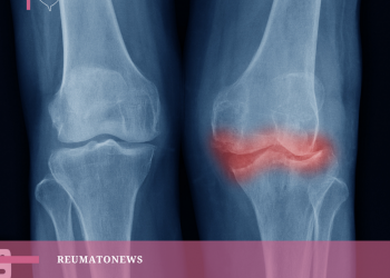 Já ouviu falar em osteoartrite? Conheça os sintomas da doença que cresce no mundo