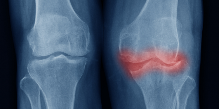 Já ouviu falar em osteoartrite? Conheça os sintomas da doença que cresce no mundo