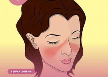 Como se manifesta o lúpus?