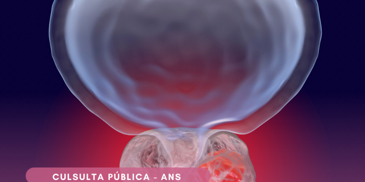 ANS abre Consulta Pública sobre inclusão de medicamentos para câncer de próstata no rol de cobertura dos planos de saúde