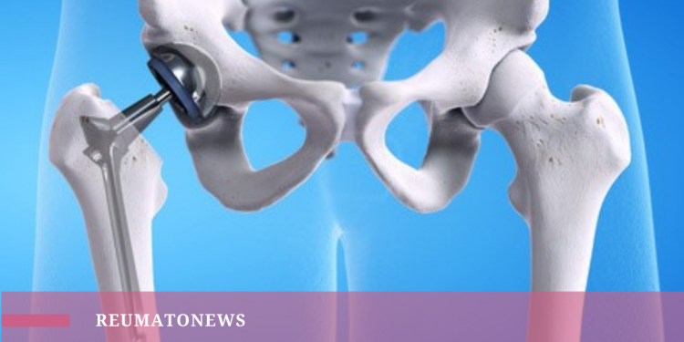 Durabilidade da prótese total do quadril pode chegar à 30 anos, apontam novos estudos