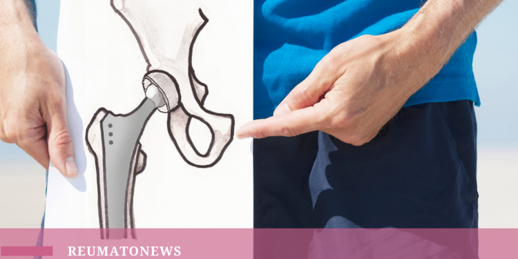 A artrose é genética? Entenda!