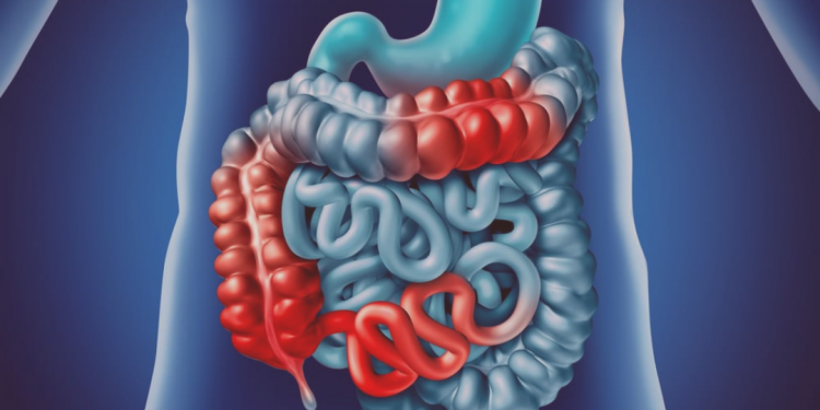 Cinco sinais da Doença de Crohn para você monitorar