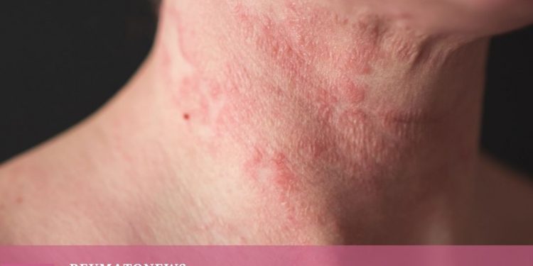 Anvisa aprova RINVOQ® (upadacitinibe) para o Tratamento de Adolescentes e Adultos com Dermatite Atópica Moderada a Grave