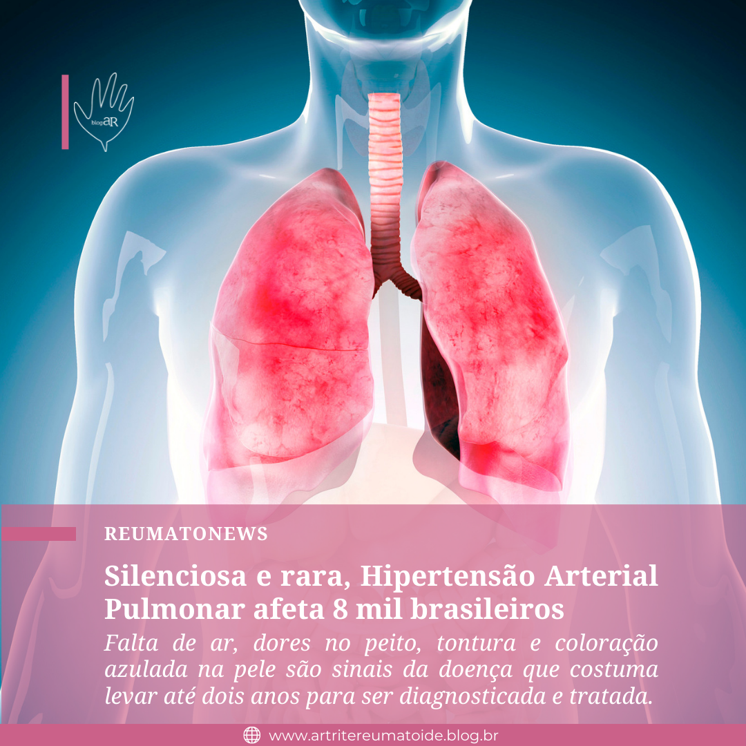 Silenciosa E Rara Hipertensão Arterial Pulmonar Afeta 8 Mil Brasileiros Artrite Reumatoide 2794