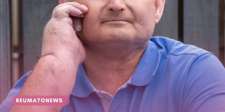 Transplante de mãos deu nova vida para homem com doença rara