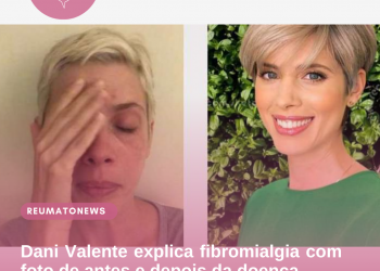 Dani Valente explica fibromialgia com foto de antes e depois da doença