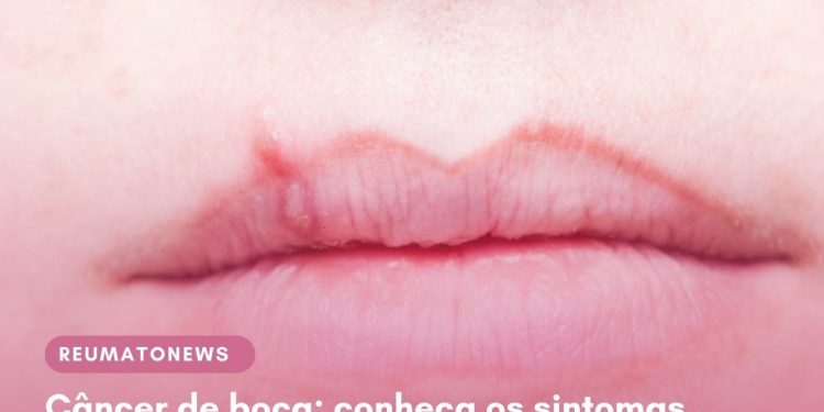 Câncer de boca: conheça os sintomas e saiba como prevenir a doença