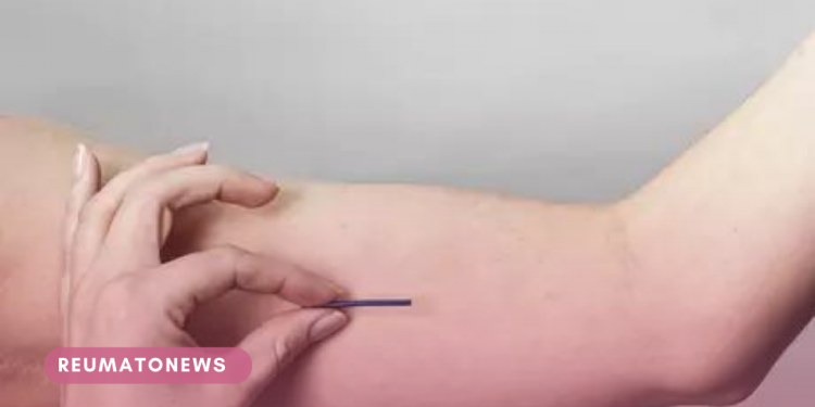 Chip da beleza: médica tira dúvidas sobre implante hormonal sucesso entre as famosas