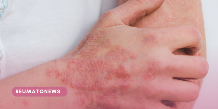 7 sinais que podem indicar psoríase