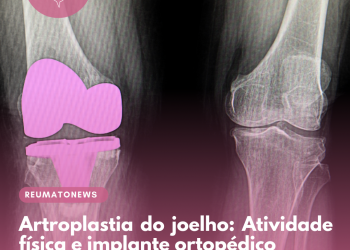Artroplastia do joelho: Atividade física e implante ortopédico