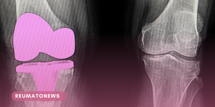 Artroplastia do joelho: Atividade física e implante ortopédico